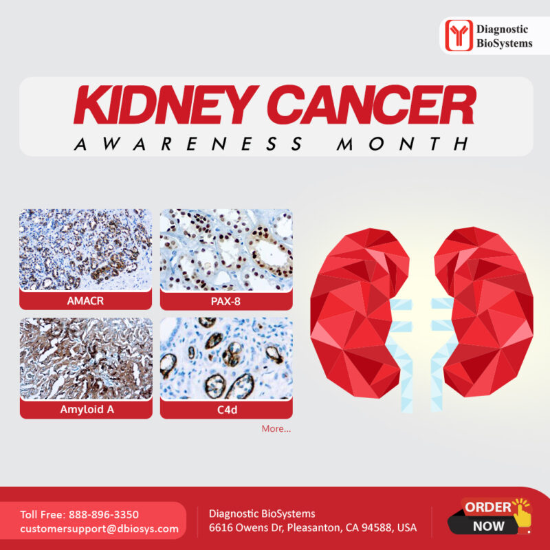 Kidney Cancer