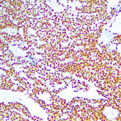 Formalin fixed paraffin embedded human seminoma stained with OCT 3/4
