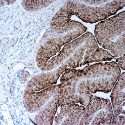 Formalin fixed paraffin embedded human Bladder carcinoma stained with UUroplakin III (AU1)