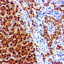 Formalin fixed paraffin embedded human hepatocellular carcinoma stained with Arginase 1