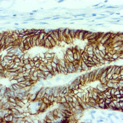 Formalin fixed paraffin embedded human colorectal carcinoma and normal colon stained with Cadherin 17