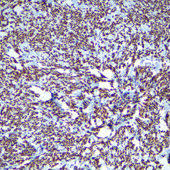 Formalin fixed paraffin embedded human Solitary fibrous tumor stained with STAT6