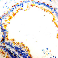 Formalin fixed paraffin embedded human Prostate stained with p63/p504s Cocktail.