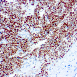 Formalin fixed paraffin embedded human Ewing’s sarcoma stained with NKX2.2.