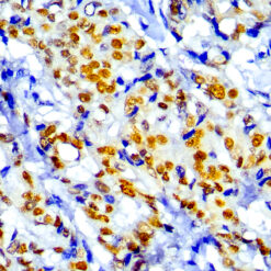 Formalin fixed paraffin embedded Breast carcinoma stained with TRPS1.